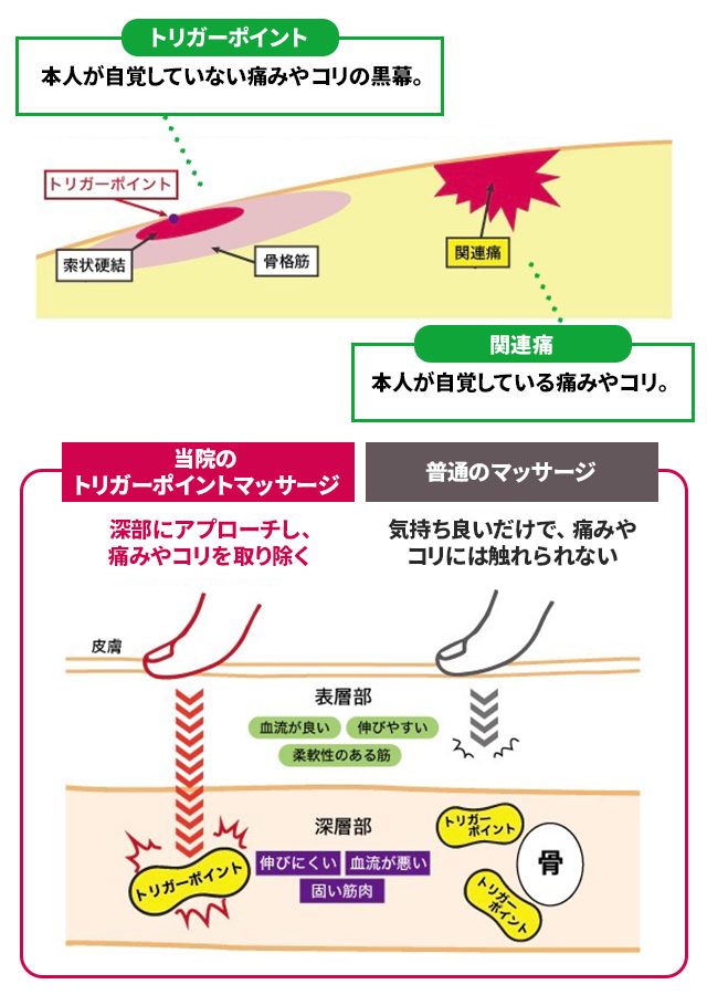 トリガーポイントについてのイラスト